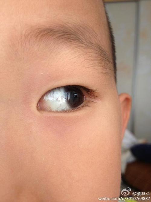 小孩子眼白有黑点是什么原因啊?