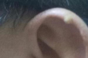 问一下耳朵长的白色的这个是什么东西,怎么引起的,怎么消除呢?