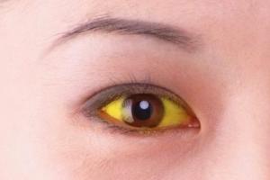黄眼珠的人面相怎么样非常冷静的人黄眼珠的人面相相术(眼珠黄的人面相)