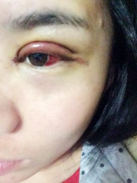 割双眼皮已经五天了还是那么肿眼球一半都是红的请问是怎么