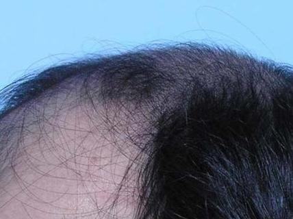 搜疾病 皮肤病 脱发 脱发的原因 > 正文  男性大量掉头发是怎么回事?