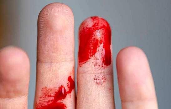 受伤,手指,手臂,血,出血胳膊流血真实图片53梦见自己手受伤如何解读