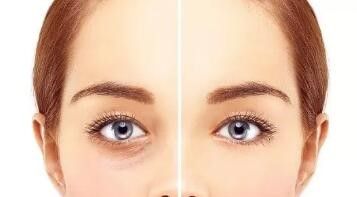 与眼部皮肤薄厚有关实际上,泪沟是天生存在的,只是因人眼部肌肤的薄厚