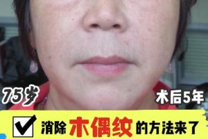 木偶纹是两侧嘴角向下延伸的皮肤皱纹,是由于面颊组织_圈子-新氧美容