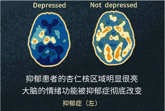 抑郁症对我们的大脑做了什么?