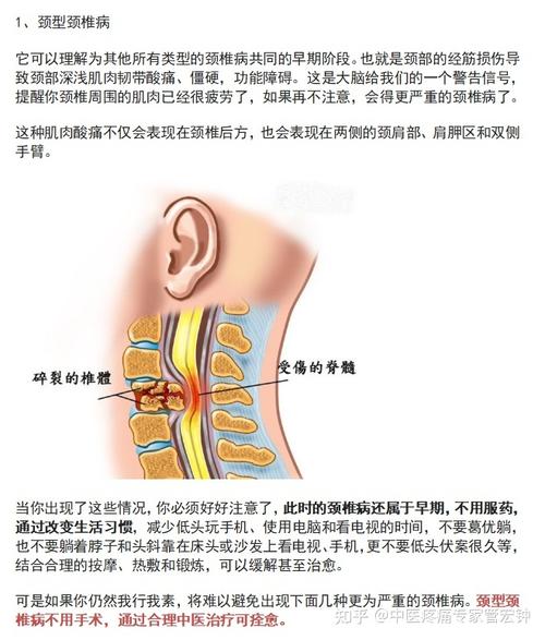 神经根型颈椎病是最常见的类型,最严重的是脊髓型,最复杂的是交感型和