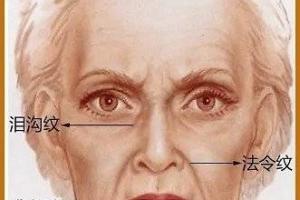 木偶纹又称括号纹,流涎纹,是长在嘴角两侧的皱纹,在口角外侧或下方显