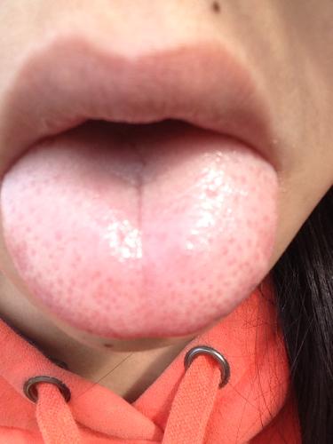 舌尖上有很多裂纹,舌头两侧边缘有红斑 舌头右侧下面有黄豆大小的白色