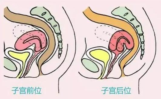 子宫后位如何怀孕与子宫前位的区别