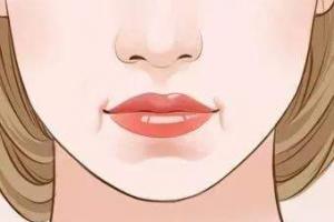 木偶纹又称括号纹,流涎纹,是指长在嘴角两侧并延伸向下的皱纹.