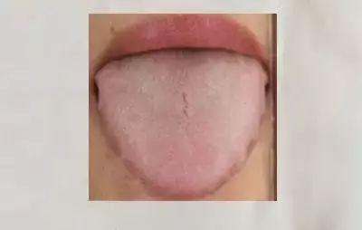 舌头边缘有齿痕气虚体质的人,舌
